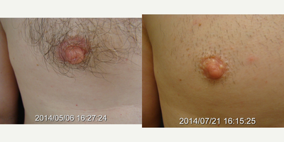 Nipple Reduction - The nipple is too large or sticks out too much. It may be difficult to conceal in clothing. A wedge of excessive nipple is removed, repairing the edges and leaving the remaining nipple tissues intact.