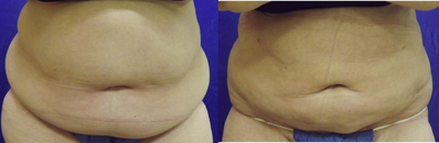 55-64 year old woman treated with Laser Liposuction - 56 year old female before and after Tickle Liposuction to her abdomen
