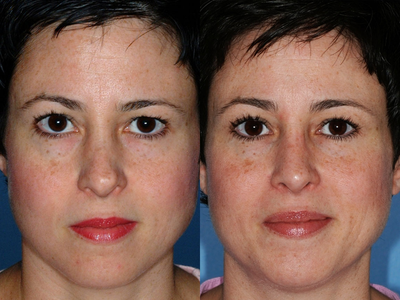 Revision Rhinoplasty - 
	This revision (secondary) rhinoplasty patient had two prior rhinoplasty surgeries in Europe. Her distorted nasal tip and collapsed bridge were corrected via an open approach using ear cartilage grafts.
