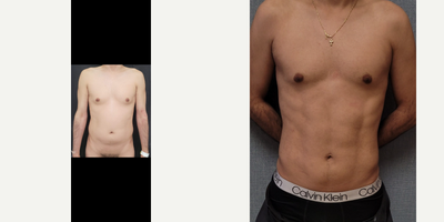 35-44 year old man treated with SAFELipo - HD Lipo