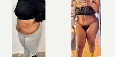 45-54 year old woman treated with Tummy Tuck, Liposuction, BodyTite - 45-54 year old woman treated with Tummy Tuck, Liposuction, BodyTite