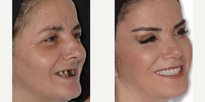 45-54 year old woman treated with Dental Bone Graft - 8 Straumann Implant Procedure in Upper and Lower Jaw, Hybrid Porcelain Prosthesis in Both Jaws, 12 Canal Treatment with Fiber Post, 11 Tooth Extractions and Full mouth Zirconium Crowns.