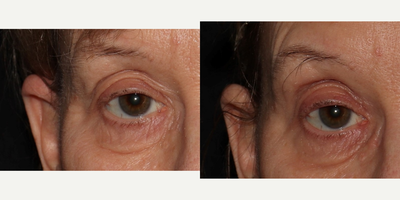 65-74 year old woman treated with Sofwave - This patient under went a single Sofwave procedure of the upper face/lid region. At just 1 month post-procedure she already has a very nice tightening result. This result will continue to improve over the course of the next few months, and as the result is due to new collagen formation the result will be very long lasting.