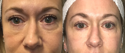 35-44 year old woman treated with Fat Transfer - It takes about 3-6 months for the fat transfer to really settle it. Take a look at this woman's periorbital area and cheek malar prominence. She has a great result. Natural and smooth. We are even able to open up the cheek folds with the temple injections.