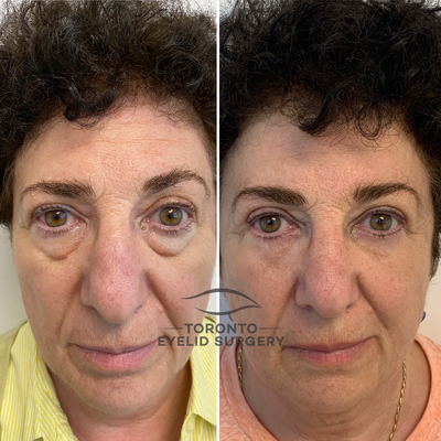 55-64 year old woman treated with Canthoplasty, Eyelid Surgery - Upper blepharoplasty and lower lid blepharoplarty with skin pinch and lateral canthopexy. She asked for a natural rejuvenation and a beautiful fresh look she got.