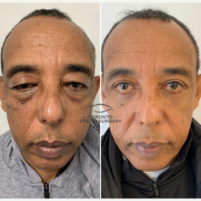 45-54 year old man treated with Eyelid Surgery, Ptosis Surgery - Upper and lower lid blepharoplasty + Lid ptosis repair.