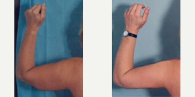 Woman treated with Arm Lift - Woman treated with Arm Lift
