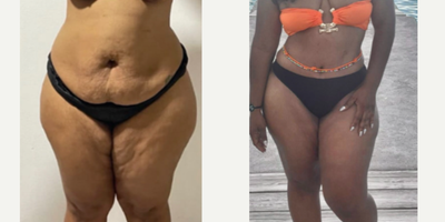 35-44 year old woman treated with Tummy Tuck, Liposuction, Brazilian Butt Lift - Excellent outcome after full tummy tuck combined with intense liposuction including abdomen, waist, laterals and upper and lower back to improve your body contour and get better curves, especially in your waist area and dominican butt lift.