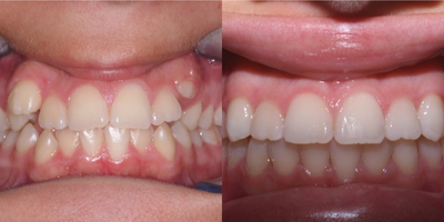15 Year Old Female Treated With Braces - I rarely recommend extracting teeth prior to orthodontic treatment but in this case the crowding was so severe that we extracted four second molars, not bicuspids. Extracting second molars allows wisdom teeth to erupt in the second molars' position so there is no collapse of the patient's face, no collapse of lip support and no damage to the patient's airway or TMJ.