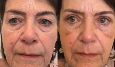55-64 year old woman treated with Eyelid Surgery - Eyelid lift surgery.