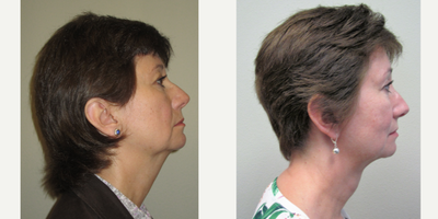 55-64 year old woman treated with Non-Surgical Neck Lift - Pt underwent Precision TX and Brow Lift