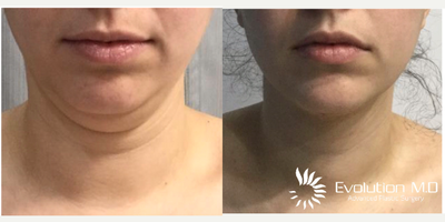 18-24 year old woman treated with Slim Lipo - Liposuction of the chin
