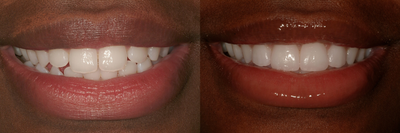 Durathin Veneers - A new smile with four Durathin Veneers - No tooth reduction.