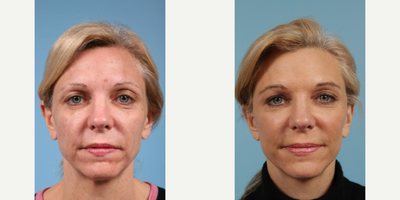 Woman treated with Lower Facelift - Woman treated with Lower Facelift