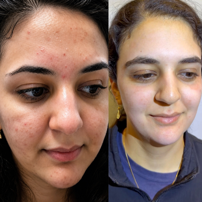 18-24 year old woman treated with CO2 Laser - The gold standard for treating acne scars and one of my favorite procedures: Advanced Deep Combination CO Laser Resurfacing!Acne scars can leave permanent changes in the skin, but with the right treatment and technique, a remarkable skin transformation is possible.Our 27-year-old patient underwent my Advanced Deep Combination CO Laser Resurfacing, and this video shows her incredible long lasting results even six years later! Long lasting and long-term outcomes like these are what make this treatment one of my favorites.Rather than simply treating the surface, this advanced approach combines multiple CO laser techniques to target different layers of the skin, stimulating powerful collagen remodeling while improving texture, contour irregularities, enlarged pores, fine lines, and overall skin quality.Every treatment is carefully customized based on scar type, skin quality, and healing characteristics to maximize improvement while maintaining a natural appearance.The goal isnt just smoother skin after a few months, its healthier, stronger, more youthful skin that continues to look beautiful for years.