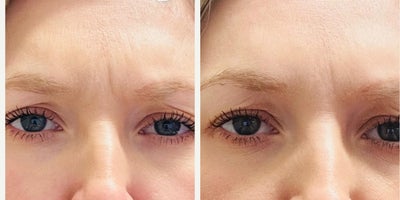 35-44 year old woman treated with Daxxify - Daxxify Injected to her Crows Feet, Glabella & Forehead