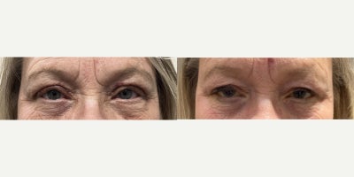 55-64 year old gender nonconforming person treated with Ptosis Surgery - Ptosis Repair - (Post-Operative Week 1)