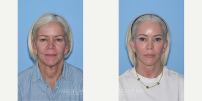 Woman treated with Facial Fat Transfer - Woman treated with endoscopic Brow Lift, Eyelid Surgery through upper blepharoplasty, Lip Lift, Facelift, and Facial Fat Transfer.Patient is shown before and 3 years post-op.