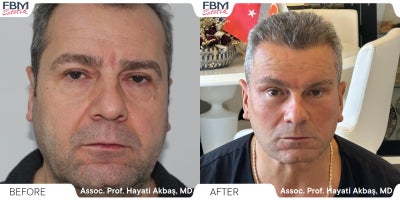 45-54 year old man treated with Deep Plane Facelift, Neck Lift, Eyelid Surgery, Facial Fat Transfer, Hair Transplant - 45-54 year old man treated with Deep Plane Facelift, Neck Lift, Eyelid Surgery, Facial Fat Transfer, Hair Transplant
