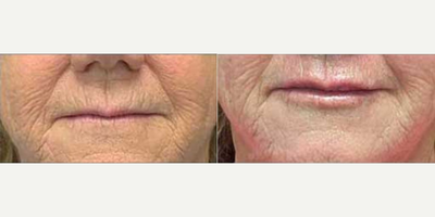 Woman treated with Secret RF - Woman treated with Secret RF.