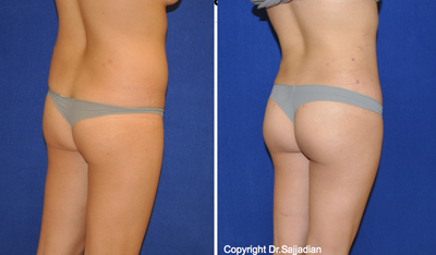 Butt Augmentation - 