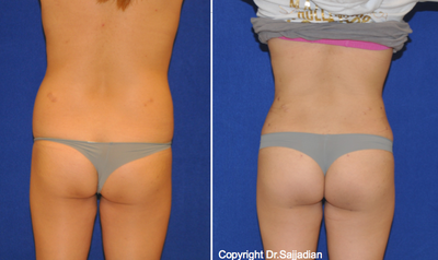 Butt Augmentation - 