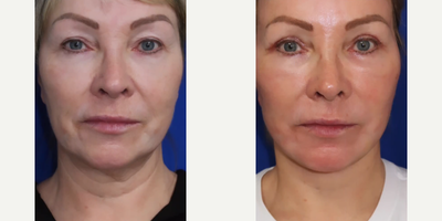 Woman treated with Facelift, Neck Lift, CO2 Laser, Eyelid Surgery - Heres a recovery journey. This patient had a FACEologyLIFT, upper eyelid blepharoplasty, and CO2 Laser skin resurfacing of the face.