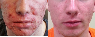 17 or under year old man treated with Accutane - Patient with severe inflammatory acne lesions on face.