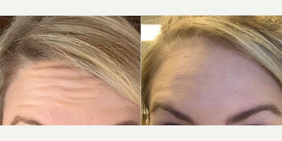 Woman treated with Botox - Woman treated with Botox.