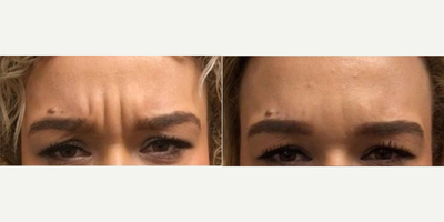 Woman treated with Botox - Woman treated with Botox.