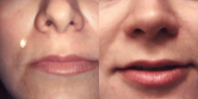 25-34 year old woman treated with Alarplasty - Nostril widening using internal flaps to correct an over-resection performed elsewhere.