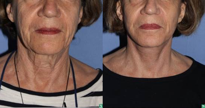 67 year old, face and neck lift with fat transfers - This 67 year old comes to see us because she is unhappy with her jowls, her neck and her overall aged appearance.  She had a face lift and neck lift with fat grafting.