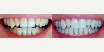 Woman treated with Teeth Whitening - Woman treated with Teeth Whitening