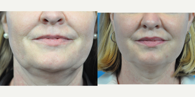 45-54 year old woman treated with Non Surgical Face Lift - Face/Necktite procedure before and after photos - Photos taken 6 weeks post-procedure