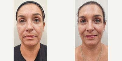55-64 year old woman treated with Dysport, Sculptra, Radiesse, Alastin Skincare - Tailored treatment plan with combined procedures on same session: Dysport on upper third of the face2 vials of Sculptra for the whole face2 vials of reconstituted Radiesse for the neckAlastin Skincare started after her first consultation