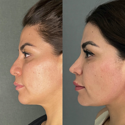 Structural Rhinoplasty - Rhinoplasty Blepharoplasty Anterior Necklift