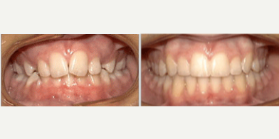 18-24 year old man treated with Damon Braces - Patient before and after photos with the Damon system