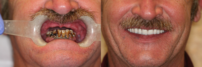 50 year old male treated with All-on-4 Dental Implant Procedure - 50 year old male treated with All-on-4 Dental Implant Procedure