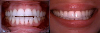 Invisalign - Invisalignwas used in this case to treat open bite.