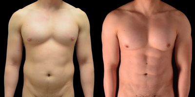 25-34 year old man treated with Liposculpture - Hi Definition Abdomen and Chest Sculpting with Fat Transfer To Shoulders For Projection and Definition -- 2 Days