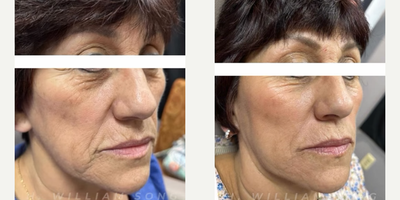 Woman treated with PRF Treatment, Skin Rejuvenation - Woman treated with PRF Treatment, Skin Rejuvenation