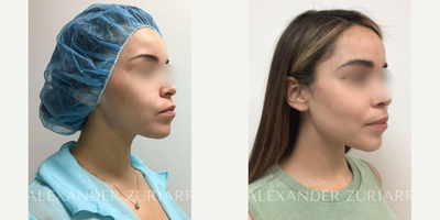25-34 year old woman treated with Buccal Fat Removal - 25-34 year old woman treated with Buccal Fat Removal- 8 months post-op