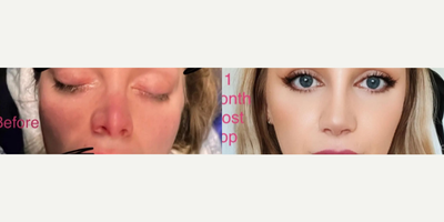 Woman treated with Revision Rhinoplasty - Woman treated with Revision Rhinoplasty, shown 1 month post op.