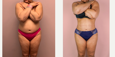 55-64 year old woman treated with Liposuction, Brazilian Butt Lift - This patient underwent a 360 Liposuction procedure with fat grafting to the buttocks/hips.