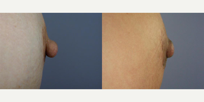 30 year old woman treated with Nipple Surgery - 30 year old woman treated with Nipple Surgery - Areola Correction
