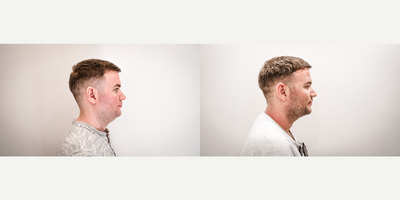 25-34 year old man treated with Chin Liposuction - Power assisted Liposuction to correct double chin deformity