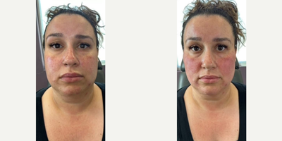 Woman treated with Voluma - Woman treated with Voluma