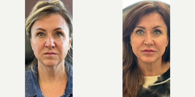 Woman treated with Voluma, Juvederm, Lip Fillers - This patient received Voluma in her cheeks and chin, and Ultra to the lips.
