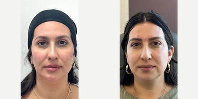 Woman treated with Voluma, Juvederm, Lip Fillers - This shows the patient after receiving Voluma to her cheeks, Volux in the jawline & Ultra to her lips.