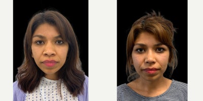 25-34 year old woman treated with Asian Rhinoplasty, Rhinoplasty - Patient with a wide nose , bulbous tip and alar flaring. A rhinoplasty to narrow the nose has been performed . This has narrowed the the bridgeline, refined the nasal tip and reduced the nsotril flare. The result is only at 6 weeks. The scar on the basal view from under the nose is still slightly red at 6 weeks after surgery. This will fade over a few months.